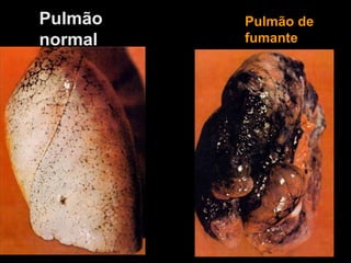 Pulmão normalPulmão de fumante