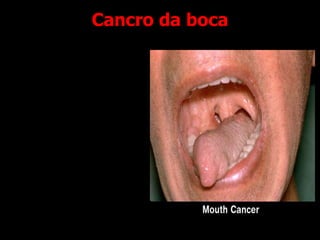 Cancro da boca