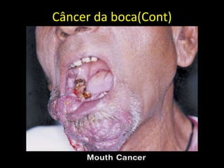 Câncer da boca(Cont)