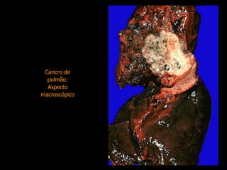 Cancro de pulmão: Aspecto macroscópico