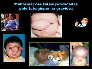 Malformações fetais provocadaspelo tabagismo na gravidez
