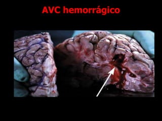 AVC hemorrágico