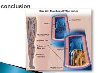 Tabagisme et thrombose habbal
