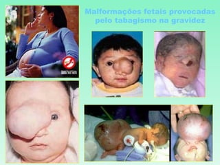 Malformações fetais provocadas pelo tabagismo na gravidez 