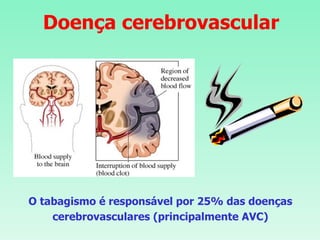 Doença cerebrovascular O tabagismo é responsável por 25% das doenças cerebrovasculares (principalmente AVC) 