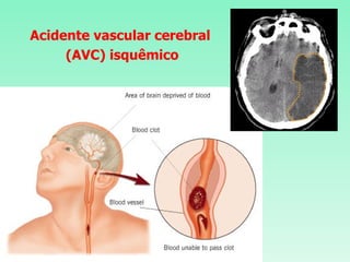 Acidente vascular cerebral (AVC) isquêmico 