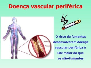 Doença vascular periférica O risco de fumantes desenvolverem doença vascular periférica é  10x maior do que  os não-fumantes 