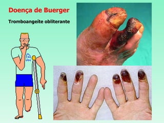 Doença de Buerger Tromboangeíte obliterante 