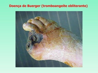 Doença de Buerger (tromboangeíte obliterante) 