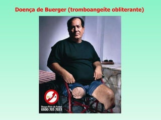 Doença de Buerger (tromboangeíte obliterante) 