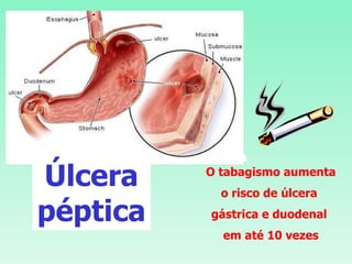O tabagismo aumenta o risco de úlcera  gástrica e duodenal  em até 10 vezes Úlcera péptica 