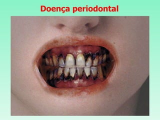 Doença periodontal 