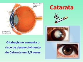 Catarata O tabagismo aumenta o risco de desenvolvimento de Catarata em 2,5 vezes 