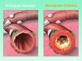 Brônquio Normal Bronquite Crônica 