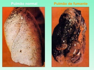 Pulmão normal Pulmão de fumante 