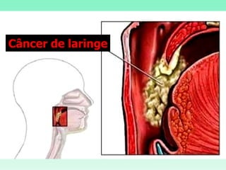 Câncer de laringe 