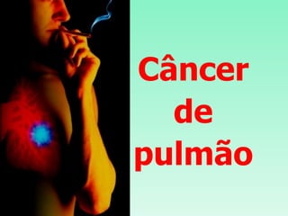 Câncer de pulmão 