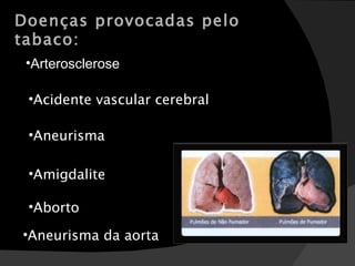 Doenças provocadas pelo tabaco: Arterosclerose Acidente vascular cerebral Amigdalite Aborto Aneurisma da aorta Aneurisma 