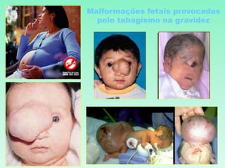 Malformações fetais provocadas
pelo tabagismo na gravidez
 