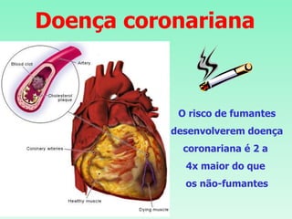 Doença coronariana
O risco de fumantes
desenvolverem doença
coronariana é 2 a
4x maior do que
os não-fumantes
 