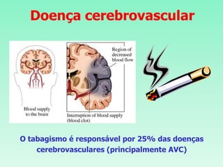 Doença cerebrovascular
O tabagismo é responsável por 25% das doenças
cerebrovasculares (principalmente AVC)
 