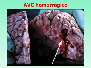 AVC hemorrágico
 
