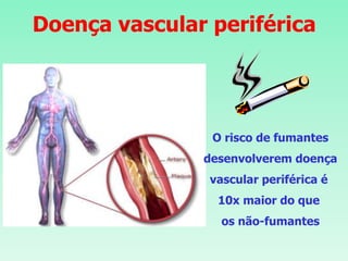 Doença vascular periférica
O risco de fumantes
desenvolverem doença
vascular periférica é
10x maior do que
os não-fumantes
 