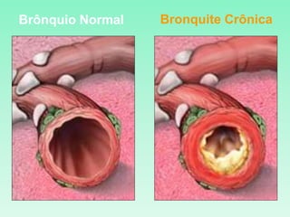 Brônquio Normal Bronquite Crônica
 