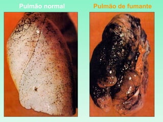 Pulmão normal Pulmão de fumante
 