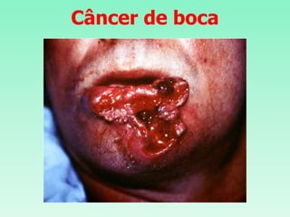 Câncer de boca
 