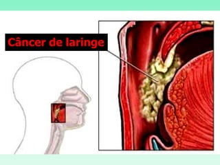 Câncer de laringe
 