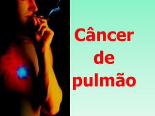 Câncer
de
pulmão
 