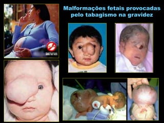 Malformações fetais provocadas
pelo tabagismo na gravidez
 
