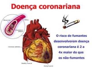 Doença coronariana
O risco de fumantes
desenvolverem doença
coronariana é 2 a
4x maior do que
os não-fumantes
 