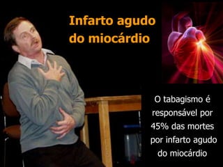 Infarto agudo
do miocárdio
O tabagismo é
responsável por
45% das mortes
por infarto agudo
do miocárdio
 
