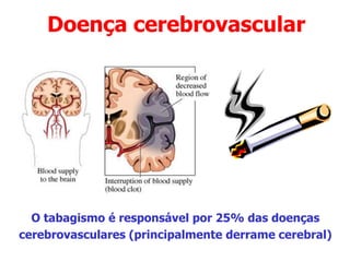 Doença cerebrovascular
O tabagismo é responsável por 25% das doenças
cerebrovasculares (principalmente derrame cerebral)
 