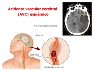 Acidente vascular cerebral
(AVC) isquêmico
 