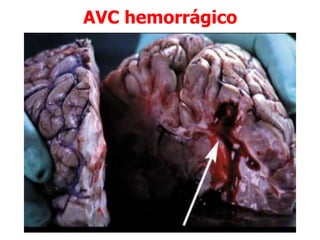 AVC hemorrágico
 