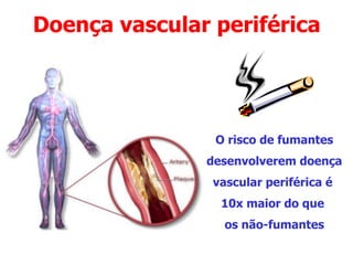Doença vascular periférica
O risco de fumantes
desenvolverem doença
vascular periférica é
10x maior do que
os não-fumantes
 