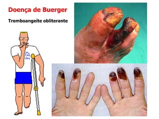 Doença de Buerger
Tromboangeíte obliterante
 