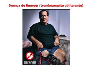 Doença de Buerger (tromboangeíte obliterante)
 