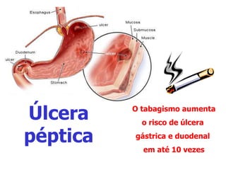 O tabagismo aumenta
o risco de úlcera
gástrica e duodenal
em até 10 vezes
Úlcera
péptica
 