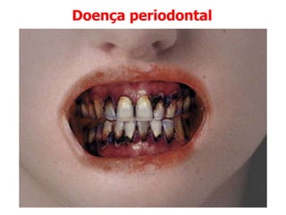 Doença periodontal
 