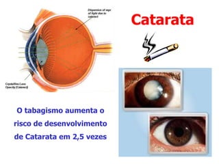 Catarata
O tabagismo aumenta o
risco de desenvolvimento
de Catarata em 2,5 vezes
 