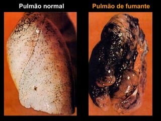 Pulmão normal Pulmão de fumante
 