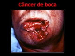 Câncer de boca
 