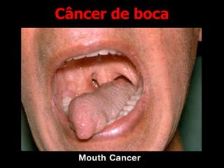 Câncer de boca
 
