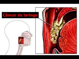 Câncer de laringe
 
