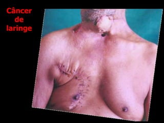 Câncer
de
laringe
 