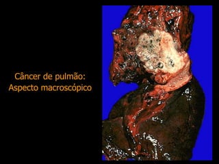 Câncer de pulmão:
Aspecto macroscópico
 